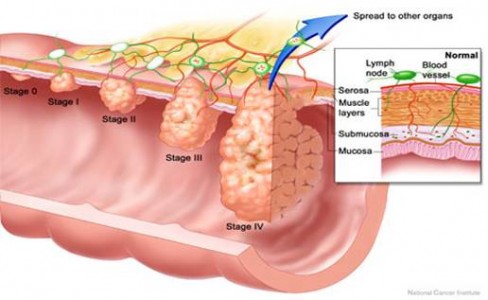 Rakovina hrubého čreva