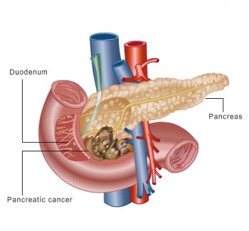 Rakovina pankreasu