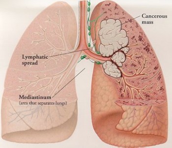 Rakovina pľúc